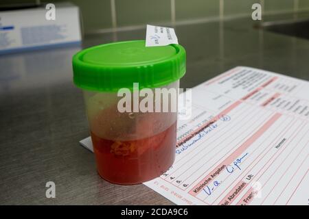 a histological tissue preparation after an operation is on a lab time Stock Photo