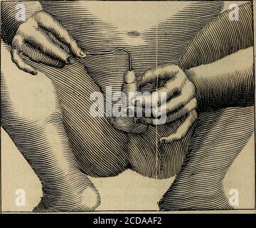Prepuce Hi Res Stock Photography And Images Page 2 Alamy