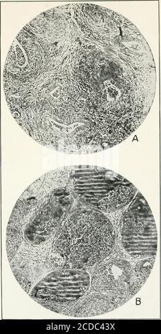 . Journal of agricultural research . Journal of Agricultural Research Vol. XVII, No. 5 PLATE 23 A.—Photomicrograph of a section from a normal seminal vesicle of bull. X 92.B.—Photomicrograph of section from seminal vesicle of bull 409, showing inflam-matory changes. X 92. PLATE 24 A.—Photomicrograph of section from seminal vesicle of bull 98, showing tissueproliferation and exfoliation of epithelium lining acini. X 92. B.—Photomicrograph of section from seminal vesicle of bull 98, showing ad-vanced pathological changes with cell degeneration and necrosis. X 92. Bacterium abortus Infection of B Stock Photo