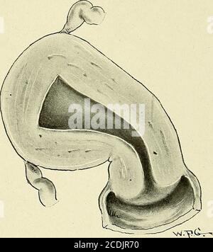 . Gynecology : . Fig. 189.—Lateral Version.. Fig. 190.—Lateral Flexion. Lateral flexion means a bending of the uterine body on the cervix to theright or left. If there has been also a version involving the cervix, one speaks ofright or left version-flexion. Anteflexion relates to forward angulation between the body and cervix.The uterus is normally anteflexed to a certain degree. The term anteflexionis used to denote an abnormal amount of angulation. The condition is de-scribed more exactly by hyperanteflexion, a word that is not in common use. Retrocession is a specialized term that relates t Stock Photo