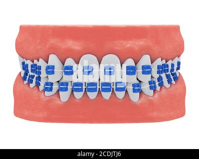 Human jaws with healthy teeth and blue braces, front view isolated, 3d render Stock Photo