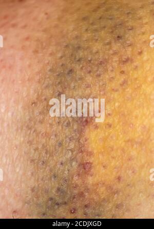 Large bruise hematoma on the humans leg on the skin in different colors Stock Photo