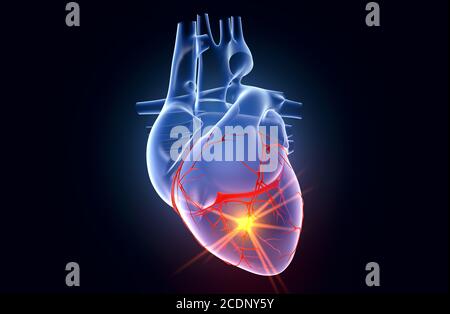 Atherosclerotic Coronary Artery Disease Stock Photo - Alamy