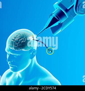 Link, neuralink, new artificial intelligence technology that allows you to connect to the human brain. Neuralink sensors ready to be installed Stock Photo