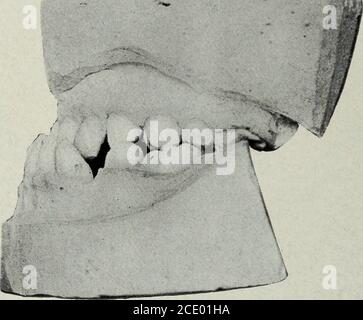 . The Dental cosmos . peration. and the obviousness of the naso-labialfolds has disappeared. Per contra, he hastwo scars below the jaw on each side. From an academic orthodontic aspectthe result is not perfect. Fig. 8 shows thepresent condition of the articulation; thepatient is wearing a partial upper denture. Measurements of Mandible From di^lnl surface of lower second molar tomesial surface of centra] incisor (cervix). From distal surface of lower second molar tosymphysis 7 mm. below cervix of centralincisor From distal surface of lower second molar tocentral incisor (incisal edge) Distance Stock Photo