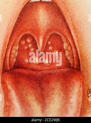 Enlarged tonsils Stock Photo - Alamy