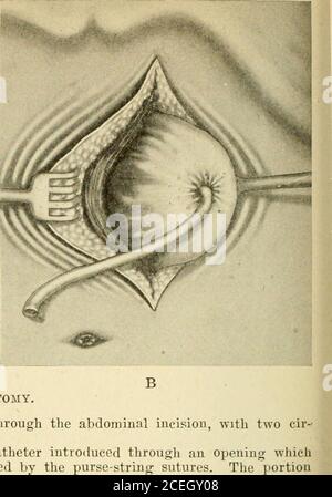 Laparoscopic Transabdominal Cerclage » Cervical Cerclage — A/Prof Alex Ades