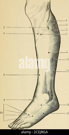 . A treatise on nervous and mental diseases, for students and practitioners of medicine. Motor points of thigh, anterior surface. Posterior surface. (From VoN Ziemssen.) Fig. 85.—1. Tensor vaginae femoris (branch of superior gluteal nerve). 2. Anteriorcrural nerve. 3. Tensor vaginee femoris (branch of crural nerve). 4. Obturator nerve.5. Eectus femoris. 6. Sartorius. 7. Vastus externus. 8. Adductor longus. 9. Vastusexternus. 10. Branch of crural nerve to quadriceijs extensor cruris. 12. Crureus. 14.Branch of crural nerve to vastus externus. Fig. 86.—1. Adductor magnus. 2. Inferior gluteal nerv Stock Photo