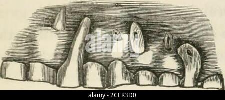. The principles and practice of dental surgery. Fig. 165.. 492 TREATMENT OF NECROSIS OF THE ALVEOLI. a large portion of the palatine plate of the bone in a necrosedstate, but the process of separation had not yet proceeded farenough to enable him to remove it. The accompanying engraving, made from a drawing fur-nished the author by Dr.Maynard, represents a caseof necrosis and exfoliationof a portion of the outerwall of the alveolar ridge, andthe consequent protrusion ofthe roots of the teeth on oneside of the mouth. The only facts which Dr. Maynard had beenable to procure in relation to this Stock Photo