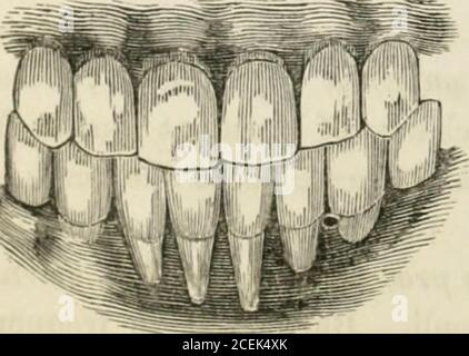 . The principles and practice of dental surgery. roots of teeth; from thence it extends tothe other teeth. The rapidity of its progress depends on theage, state of the general health, temperament and habit of bodyof the individual, and the character of the local irritants whichhave given rise to it. It is always more rapid in persons ad-dicted to the free use of spirituous liquors, and in individuals inwhom there exists a scorbutic tendency; or who have sufieredfrom venereal disease, or from the constitutional effects of amercurial treatment used to cure this or other diseases. The inflammatio Stock Photo