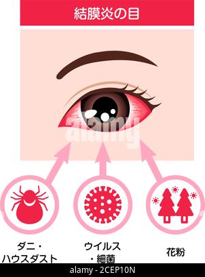 Causes of conjunctivitis (pink eye) vector illustration Stock Vector