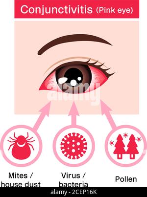 Causes of conjunctivitis (pink eye) vector illustration Stock Vector