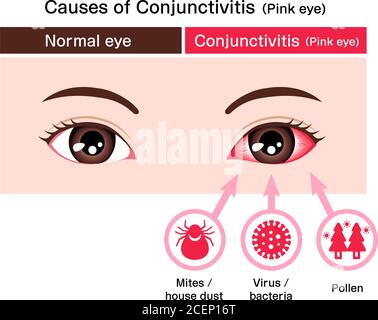 Causes Of Conjunctivitis (pink Eye) Vector Illustration Stock Vector ...