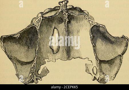 . Injuries and diseases of the jaws : the Jacksonian prize essay of the Royal College of Surgeons of England, 1867. prone to assume an abnormal position in relation to thecoronoid process, and in either position a tumour may be Fig. 100.. 216 TUMOURS CONNECTED WITH THE TEETH. formed which may be difficult of diagnosis. Dr. Forget{op. cit.) quotes the case of a woman who had^ on the leftside of the hard palate, a tumour of the form and size ofa nut, which reached beyond the median line, and extendedfrom the canine tooth to the soft palate. Blandin, on at-tempting to remove it, discovered it to