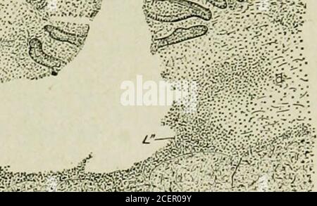 . The diseases of infancy and childhood. llicular Ulcers of the Colon A delicate child, fourteen months old, sick twelve days; stools green, yellow, brown,and watery; no blood; temperature, 100° to 101° F. The small intestine was normal; ulcers throughout colon. The specimen is fromdescending colon; the ulcers are deep, and most of them extend to the muscular coat. ACUTE ILEOCOLITIS 379 of membranous colitis is that with severe acute symptoms, both consti-tutional and local, with a duration of from six to fourteen days. Inyoung infants its symptoms and course are very irregular, and it may bef Stock Photo