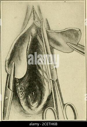. The Principles and practice of gynecology : for students and practitioners. FrarRE 247. Figure 248. Stock Photo