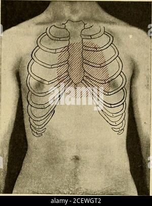 . Diseases of the heart and arterial system; Designed to be a practical presentation of the subject for the use of students and practitioners of medicine. ngs, as is sho^vn in the only instance of thiscardiac disease I have observed, and which was published in mypaper previously mentioned. A plumbers helper, aged twenty-three, was first seen by me at my clinic at Cook County Hospital,having been sent from Ward 4 as a case of pulmonary tuberculosis.Family history was meagre. His father had died of some wast-ing disease with cough; his mother of cancer; two sisters living PULMONARY STENOSIS 181 Stock Photo