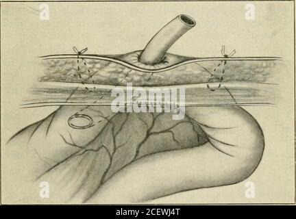 a manual of gyncology and pelvic surgery for students and practitioners fig 279enterostomy insertion of purse string suture and tube of the intestine the abdominal incision thoroughly protectedwith rubber dam and sponges the intestine opened a tube quicklyinserted and the purse string tied the purse string preventsleakage for a day or two after which time sufficient adhesionshave formed to protect the peritoneal cavity if opening of intestinal obstruction enterostomy 633 the intestine can be deferred for 24 hours it is safer to do sowhen a simple incision with the cautery is 2cewj4t