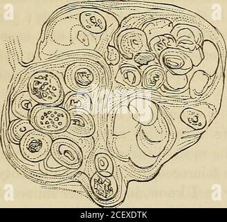 . Lectures on surgical pathology : delivered at the Royal College of Surgeons of England. consistence, with all the gradations to which I have already referred;and, in texture, in some specimens, it is pellucid, hyaline, scarcelyvisible; in some, dim, like glass breathed on; in many more, it is Fig. 61. § Fig. 62. !|. Stock Photo