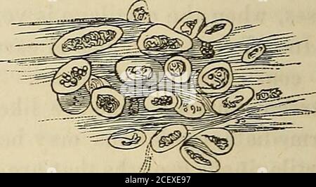 . Lectures on surgical pathology : delivered at the Royal College of Surgeons of England. consistence, with all the gradations to which I have already referred;and, in texture, in some specimens, it is pellucid, hyaline, scarcelyvisible; in some, dim, like glass breathed on; in many more, it is Fig. 61. § Fig. 62. !| Stock Photo