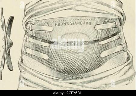 . Abdominal hernia : its diagnosis and treatment. II. Combinalioa belt and umbilical pad.. 12. Combinalion belt and umbilical pad with springs outside of belt. MECHANICAL TREATMENT: UMBILICAL. 365 Group of Adult Umbilical Trusses {Continued), Stock Photo