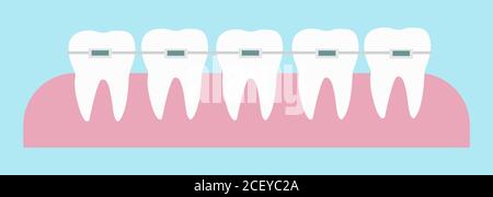 Teeth with orthodontic dental braces correction on the gums vector illustration Stock Vector