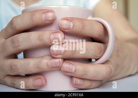 Do Your Nails Look Strange? 4 Possible Causes of Pale Nail Beds, White  Spots, Yellow Nails, and Indents