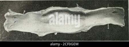 . Annals of surgery. Segment of vena cava transplanted on the abdominal ...