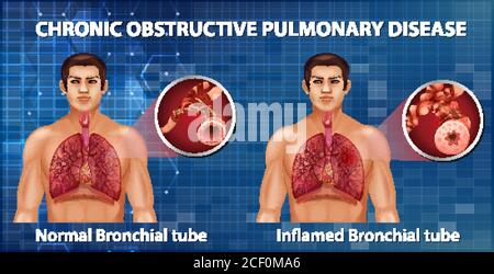 Chronic obstructive pulmonary disease illustration Stock Vector