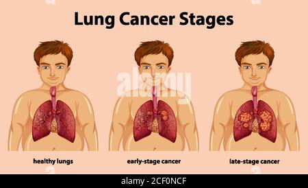 Informative illustration of lung cancer stages illustration Stock ...