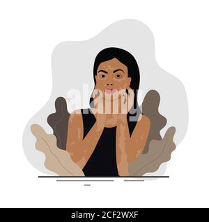 Woman with pale white vitiligo patches. Holding hand on her face. Beauty standards, health, skin conditions, dermatology and immune disease. Stock Photo