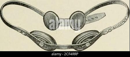 . Abdominal hernia : its diagnosis and treatment. MECHANICAL TREATMENT. 139 Groii (II Trusses ok Hood Tvi-k i Continue J).. Stock Photo