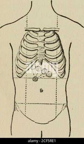 . Lectures on the diagnosis of abdominal tumors, delivered to the post-graduate class of Johns Hopkins university, 1893. of the umbilicus,there was felt a rounded tumor aboutthe size of an English walnut, freelymovable. On inflation, the stomachtympany extends two fingers breadthbelow the umbilicus. The patient remained in hospitalfor a couple of weeks; had no specialgastric symptoms, gained in weight,and returned to his home November27th. The case was regarded as oneof tumor of the pylorus, and he wastold if the trouble increased an oper-ation might be advisable. October 19, 259;?.—Patient ex Stock Photo