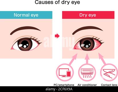 Causes of dry eye vector illustration Stock Vector