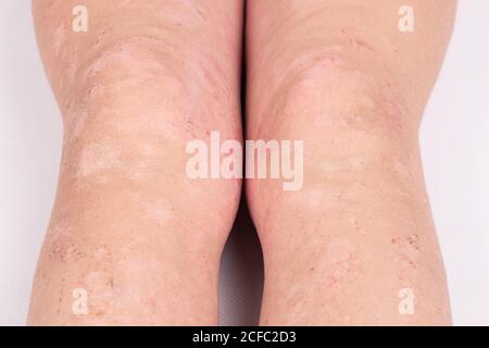 rash on children's legs close-up, redness of the skin, allergic reaction. Stock Photo