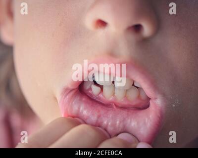 Unsteady baby tooth in wide open mouth of anonymous child pulling lip down to show tooth Stock Photo