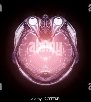 MRI brain scan sagittal flair for detect Brain diseases sush as stroke ...