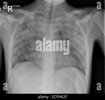 X-Ray of the chest in a patient with Active pulmonary Tuberculosis (TB) showing pneumonia and cavitation scattered in both lungs. Stock Photo