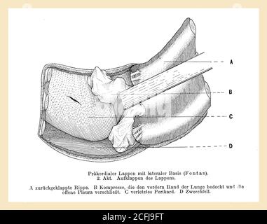 Healthcare and medicine: drawing explaining how to unfold a precordial lobe in a surgical operation with German description Stock Photo