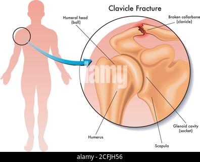 Medical illustration of a clavicle fracture and its location in the human body, with annotations. Stock Vector