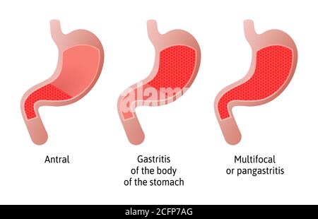 Location of Gastritis, an inflammation of the lining of the stomach. Three types Antral, of the body and pangastritis. Medical vector illustration Stock Vector