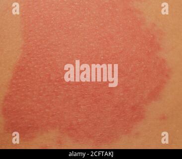 Urticaria or hives on the back, on the shoulder red rashes, itchy bumps ...