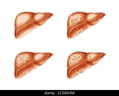 anatomical illustrations of liver disease Stock Photo