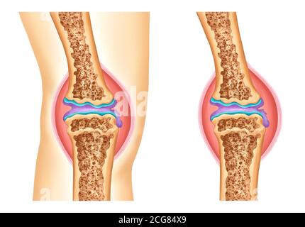 anatomical illustration of knee osteoarthritis Stock Photo