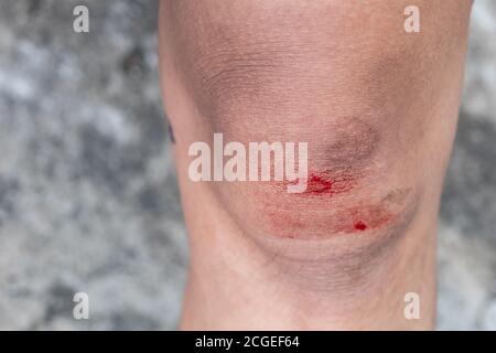 The knee is scratched. Close up on an bleeding scraped child his knee ...