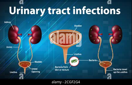 Informative illustration of urinary tract infections illustration Stock Vector