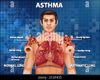 Asthma diagram with normal lung and asthmatic lung illustration Stock ...