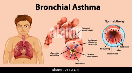 Asthma inflamed bronchial tube illustration Stock Vector