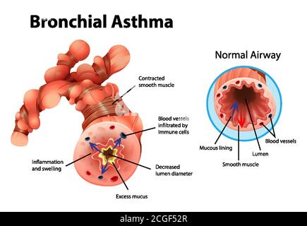 Asthma inflamed bronchial tube illustration Stock Vector