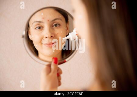 Young caucasian woman is applying cream against acne and chicken pox looking in mirror Stock Photo